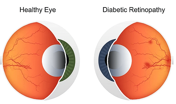 Opticians Can Indeed Detect Diabetes