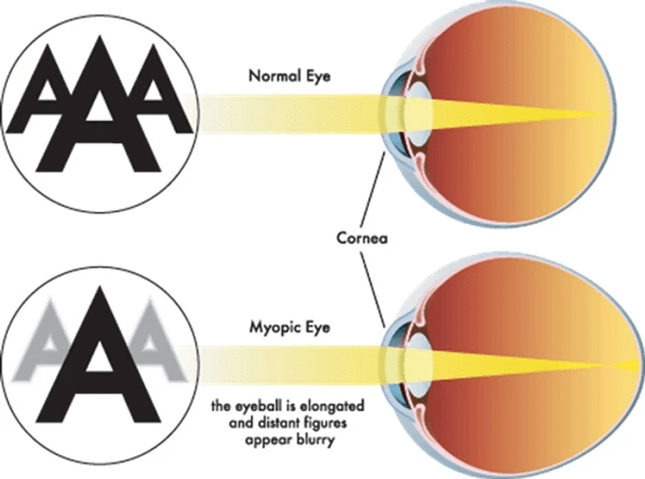what makes a person near sighted