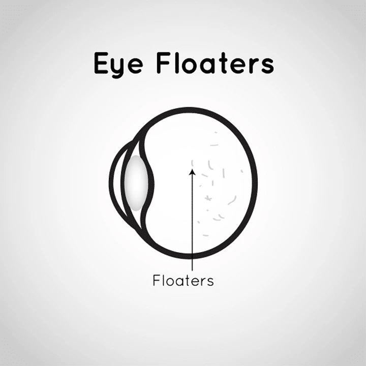 Eye Floaters (1)