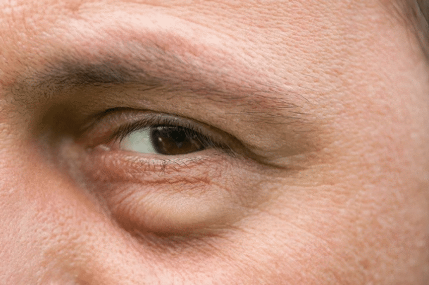 What Causes Under Eye Bags?